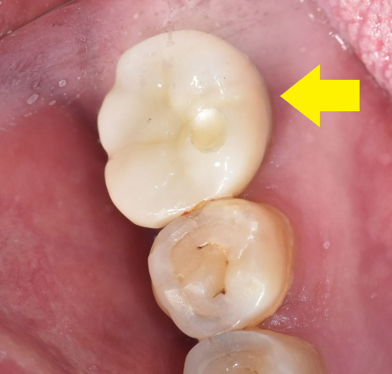 신경치료 후 통증 치아 뿌리 금으로 발치 후 강일역 임플란트 관련 이미지 7
