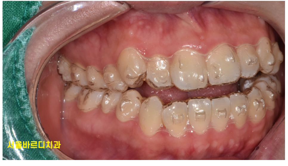투명교정장치 착용 20시간 이상 할 자신이 없다면 고민해보세요! 관련 이미지 2