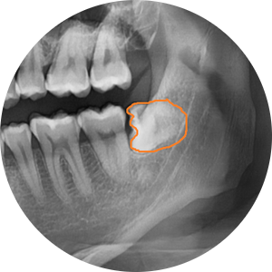 상일동 치과 매복 사랑니 발치 비용 정리해보았습니다!! 관련 이미지 3