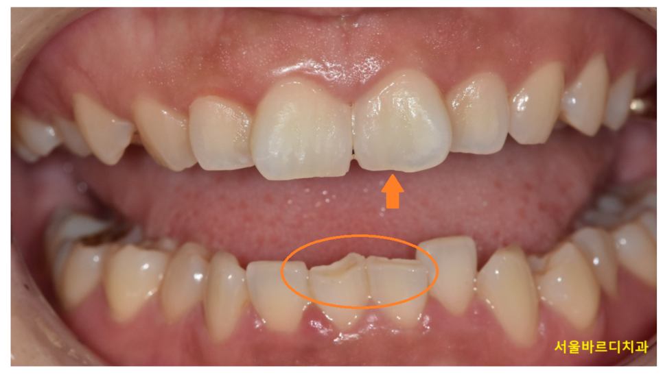 아랫니가 안보여요 과개교합 원인, 문제점 알아보아요! 관련 이미지 5