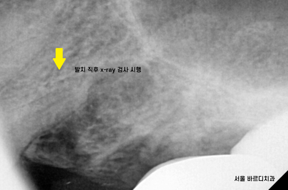 하남 미사 치과 발치 후 당일 임플란트가 가능합니다. 관련 이미지 5