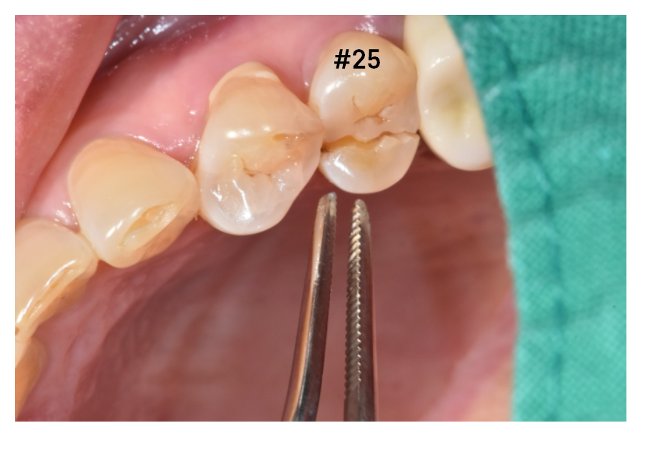 치아 쪼개짐으로 상악동 거상술 동반한 임플란트 수술 관련 이미지 2