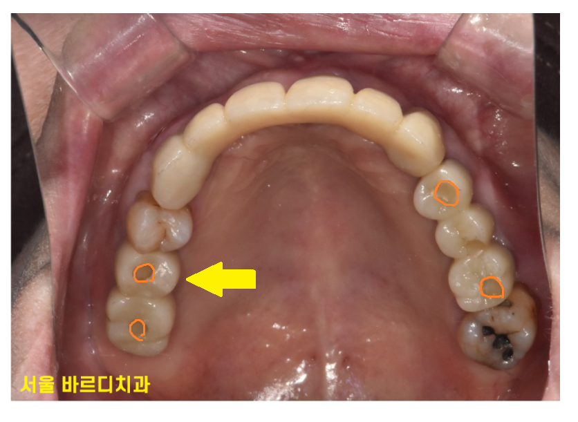 강동구 치과 임플란트 흔들림 나사 풀림 머리가 돌아가요!!! 대처법은? 관련 이미지 2