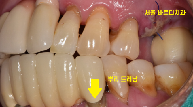 강동구 치과 앞니 흔들림 임플란트 케이스 관련 이미지 2