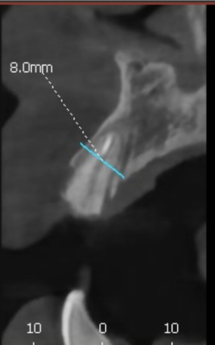 앞니 브릿지 부러짐, 이런 상태라면 절대 브릿지 다시 하지 마세요. 관련 이미지 8