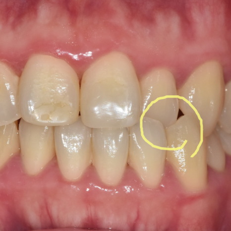 Sangil-dong Orthodontic Dentist: Do Protruding Front Teeth Really Need Orthodontic Treatment? image 5