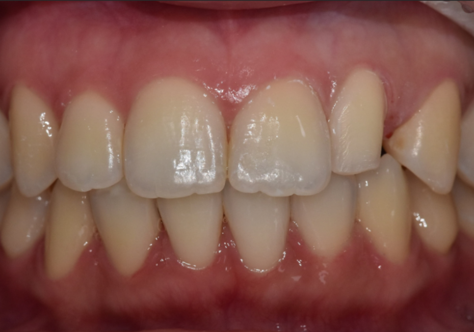 상일동역 라미네이트, 왜 누군가는 부작용을 겪고, 누군가는 10년 넘게 멀쩡할까? 관련 이미지 6