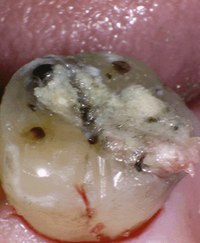 크라운 탈락 빠짐, 빠졌을 때 그대로 다시 붙일 수 있나요? 관련 이미지 2