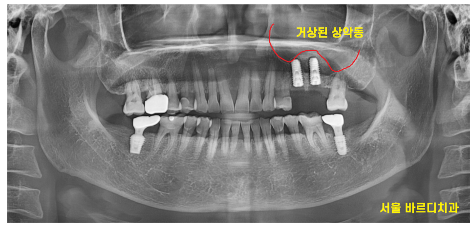 치아 쪼개짐으로 상악동 거상술 동반한 임플란트 수술 관련 이미지 9