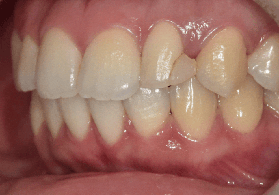 상일동역 라미네이트, 왜 누군가는 부작용을 겪고, 누군가는 10년 넘게 멀쩡할까? 관련 이미지 4