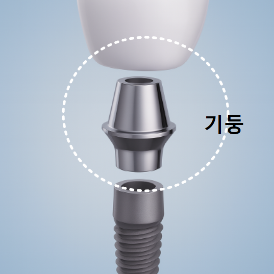 보험 임플란트 비용, 왜 치과마다 이렇게 다를까? 관련 이미지 9