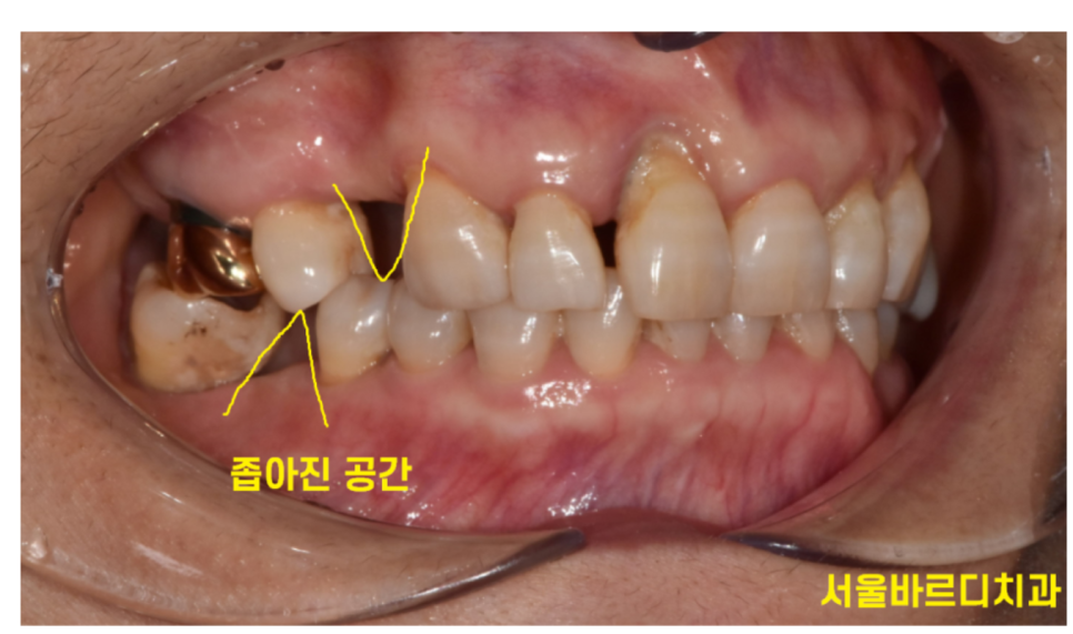 상일동 치과 치아 하나 빠지면 시작 됐을 수 있습니다 관련 이미지 4