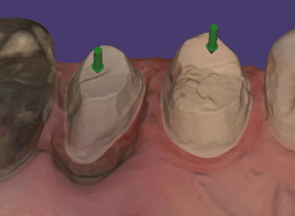 상일동역 임플란트 구강스캐너로 디지털 진료 선두하는 대표 치과입니다! 관련 이미지 1