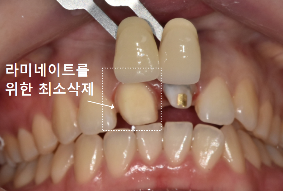 명일동 치과, 잇몸이 검게 변했다면? 앞니 변색 원인은 바로 관련 이미지 16