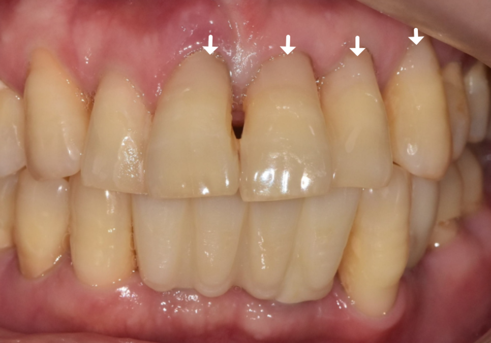 치아 시림 증상 때문에 고민이신가요? 그렇다면 양치질 너무 열심히 하지 마세요. 관련 이미지 12