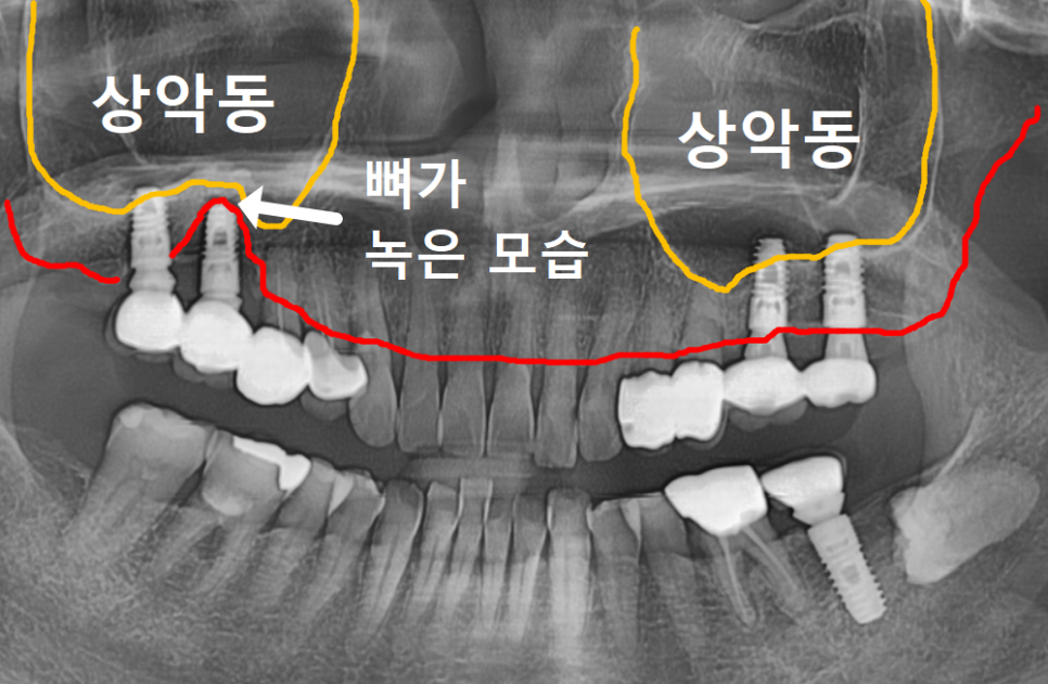 잇몸 고름 눌러보니 푹... 임플란트 주위염 방치했다가 재수술한 사례 관련 이미지 9