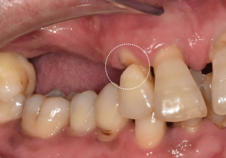 위 턱 전체 임플란트 vs 부분 틀니, 나에게 꼭 필요한 치료법 찾기 관련 이미지 4