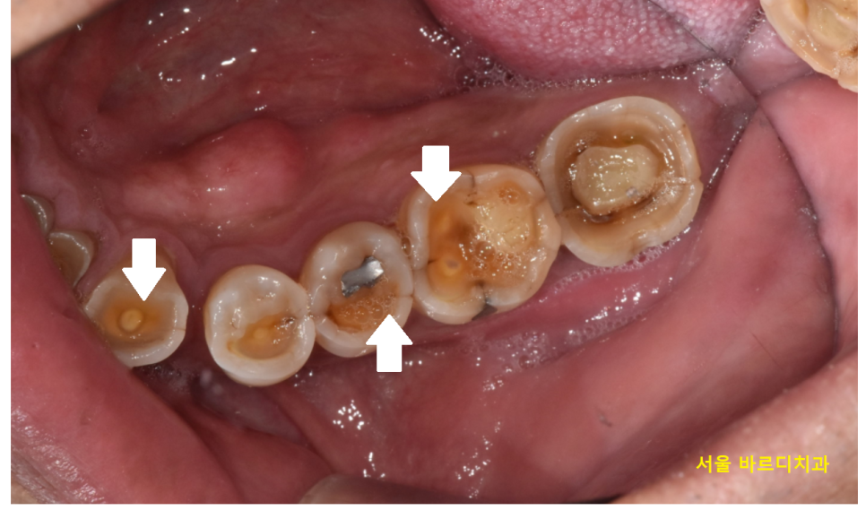 어금니 금감 발치 후 임플란트 풍산동 치과에서 진행했습니다. 관련 이미지 3
