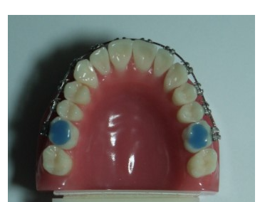 Blue Bite Blocks for Orthodontic Treatment: Everything You Need to Know, Organized image 1