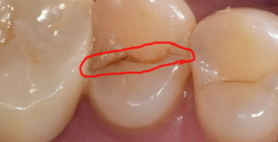 풍산동 치과 어금니 쪼개짐 임플란트를 해야할 때는? 관련 이미지 5