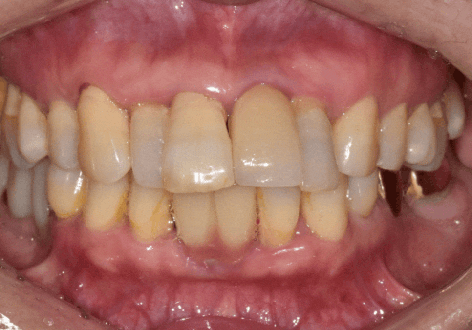 고덕동 임플란트, 튀어나온 앞니, 비용은 줄이고 자연스럽게 개선한 실제 사례 관련 이미지 15