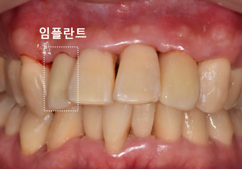 강동구 앞니 충치, 누구는 레진이고 누구는 임플란트인 관련 이미지 17
