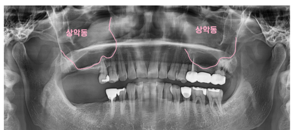 상일동역 치과 상악동 수술 후 코피 이렇게 대처하세요! 관련 이미지 2