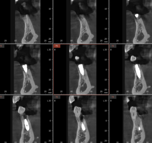 명일동 치과 심미적인 앞니는 하루만에 끝내는 빠른 임플란트로 하세요!! 관련 이미지 6