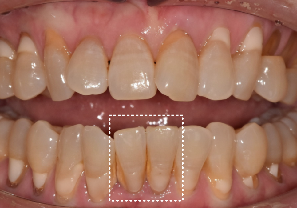 고덕동 아래 앞니 임플란트 비용 줄이는 비법, 공개합니다. 관련 이미지 4