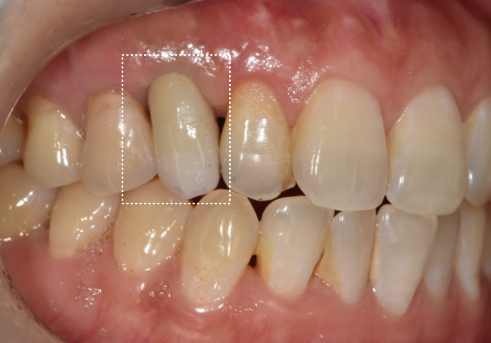 흔들리는 성인 잔존 유치, 50년 만에 송곳니 임플란트 하게 된 사연 관련 이미지 12