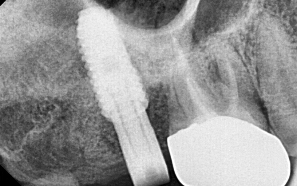 강동구 임플란트 뿌리 염증 심해질경우 대처 방법 관련 이미지 1