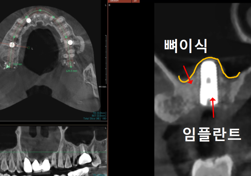 상일역 치과, 오래된 금니 빠짐, 같은 증상으로 내원했지만 전혀 다른 결과, 그 차이는? 관련 이미지 9