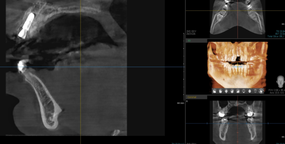 앞니 부러짐 손상이 커서 하남선동치과에서 임플란트 치료 관련 이미지 6