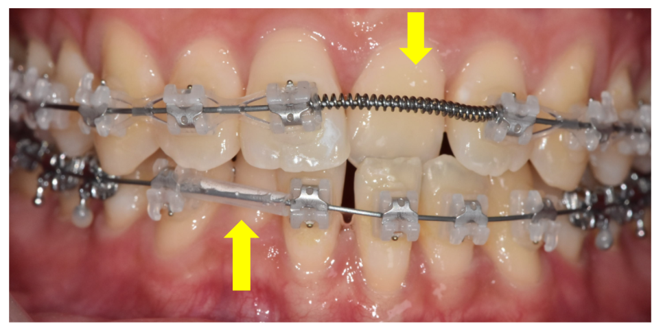 Separately or All at Once for Braces? Click Here if You’re Curious image 5