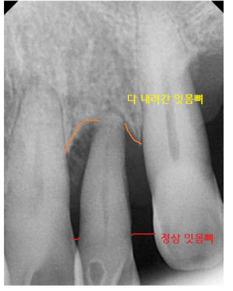 하남시청치과 디지털 임플란트를 고집하는 이유 관련 이미지 4
