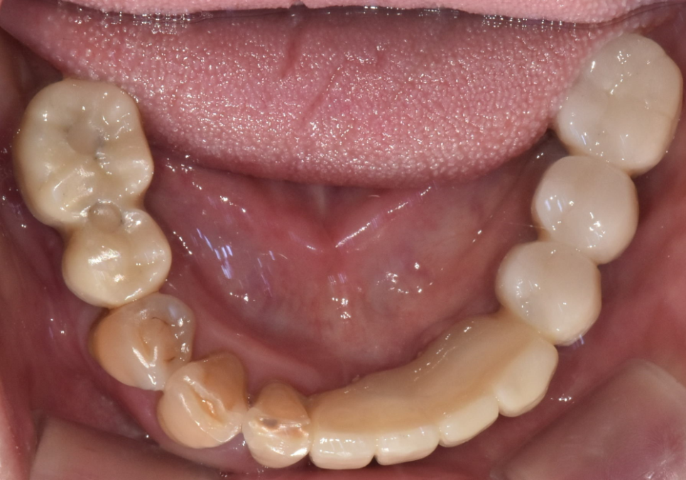 천호 디지털 가이드 임플란트, 일반 임플란트와 무슨 차이가 있나요? 관련 이미지 14
