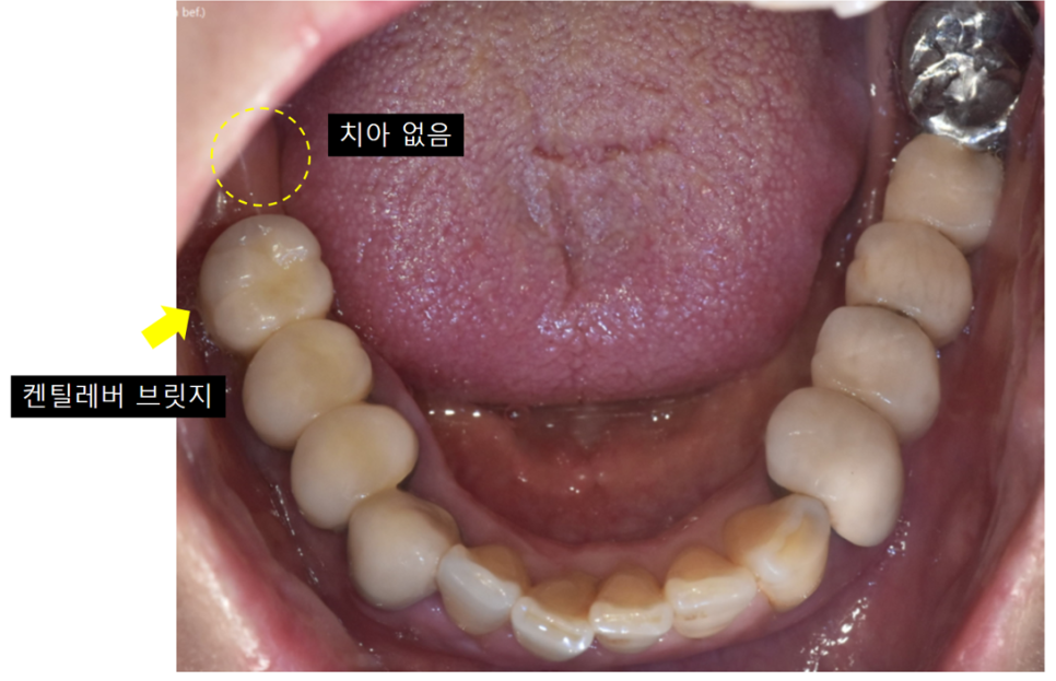 치아 닿기만 해도 아픔 원인은?? 해결은 이렇게 했습니다 관련 이미지 5