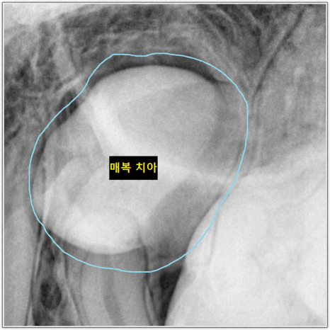 Is a University Hospital the Answer for Extracting a Completely Impacted Tooth? image 2