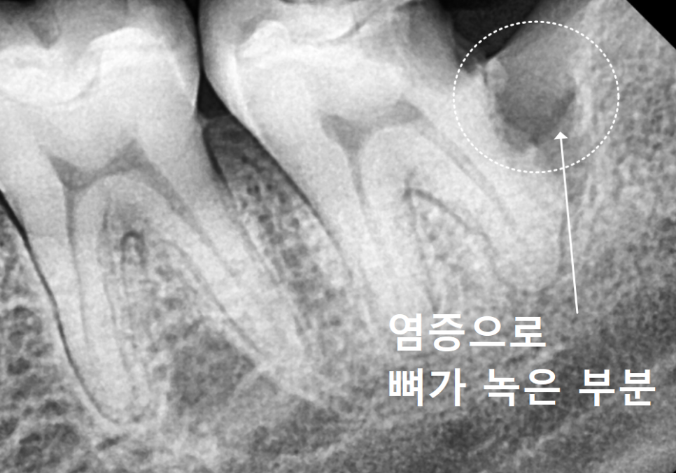 If you lightly brush your backmost molar because the toothbrush can’t reach it, this is what happens. image 6