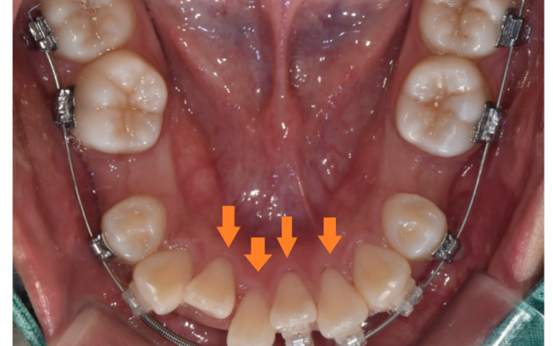 고덕동 치아교정 치아 이동 속도가 느려요 원인은? 관련 이미지 2