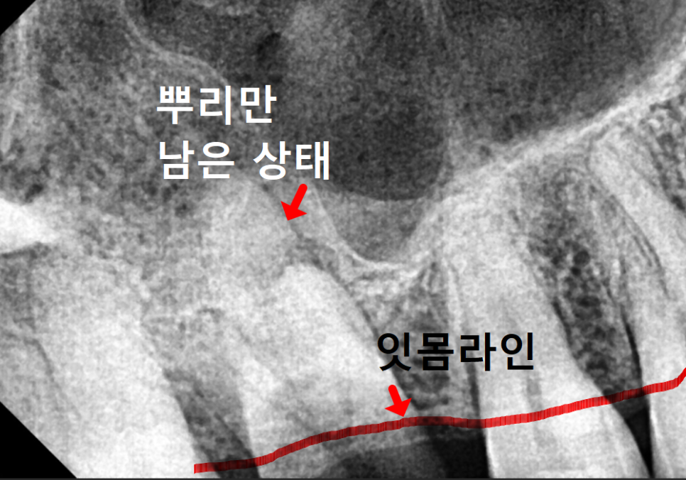 상일역 치과, 오래된 금니 빠짐, 같은 증상으로 내원했지만 전혀 다른 결과, 그 차이는? 관련 이미지 5
