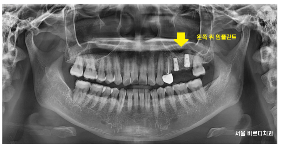 덕풍동 치과 씹을때 통증 임플란트로 극복했습니다. 관련 이미지 8