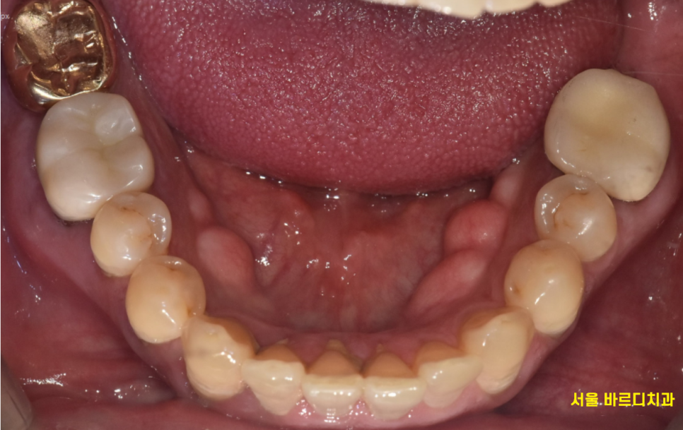 치과 엑스레이 꼭 찍어야하나요? 암사역 치과에서 답변드립니다. 관련 이미지 2
