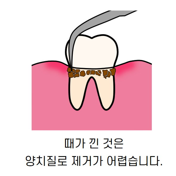 임플란트 잇몸 염증 주위염 증상이 늦게 나타납니다. 관련 이미지 3