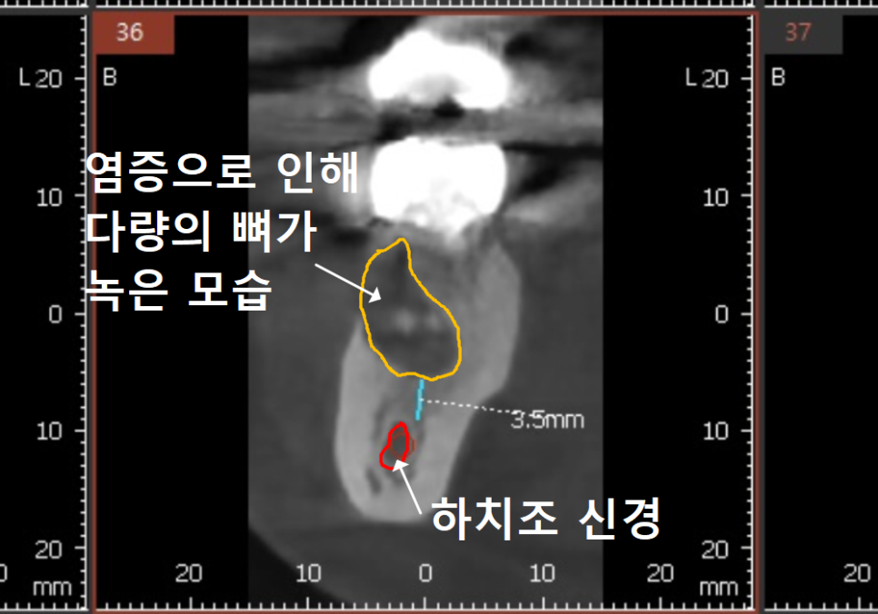 고덕역 임플란트, 뼈이식 꼭 해야 할까? 필수 상황 vs 제외 상황 총정리 관련 이미지 8
