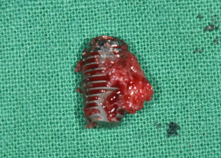 임플란트 시술 성공률, 얼마나 높을까? 처음 하시는 분들께 관련 이미지 1