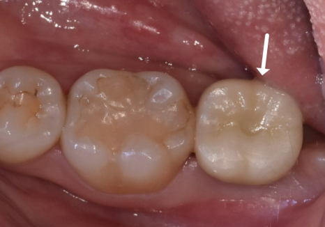 If you lightly brush your backmost molar because the toothbrush can’t reach it, this is what happens. image 16