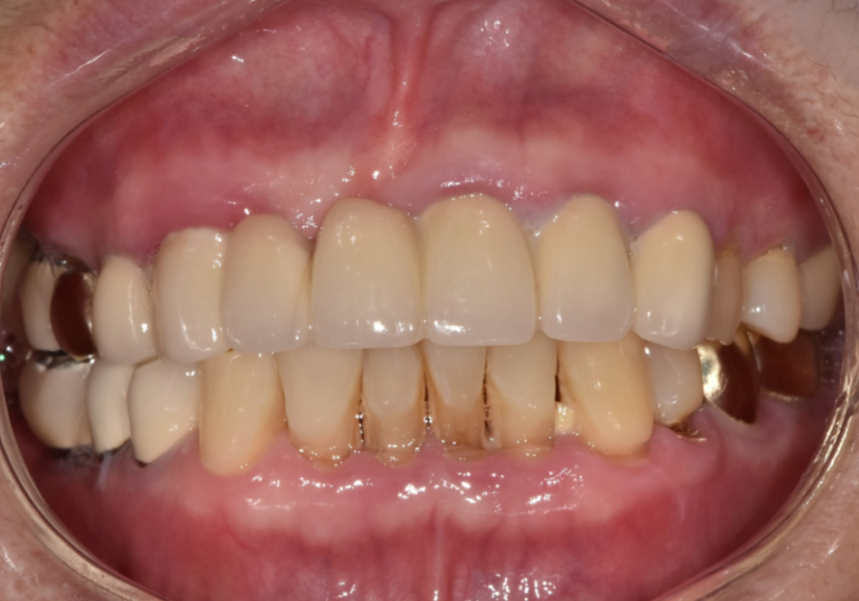 앞니 고름, 잇몸약을 먹어도 왜 염증이 가라앉지 않을까요? 관련 이미지 4