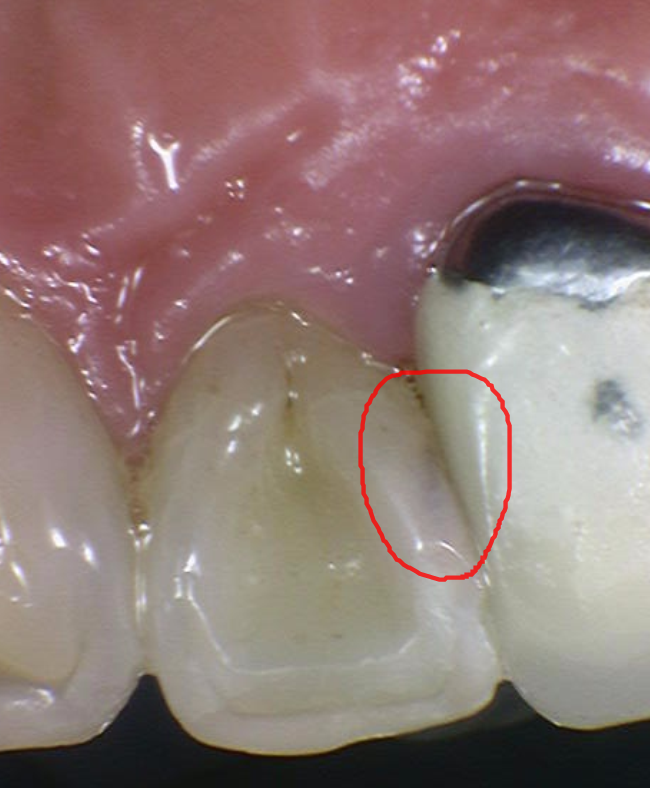 미사역 치과 앞니 충치 레진으로 당일 수복 완료하였습니다. 관련 이미지 4