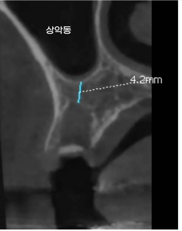 상일동역 치과 상악동 수술 후 코피 이렇게 대처하세요! 관련 이미지 4